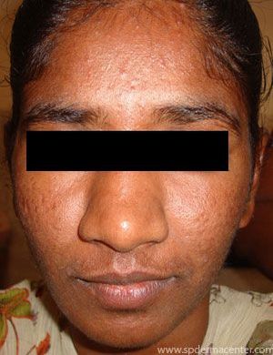 Acne-After